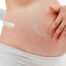 Estrías en la piel, causas y tratamientos - Dermatoclinic