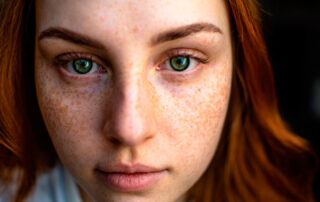 Lesiones pigmentadas de la piel, guía esencial - Dermatoclinic
