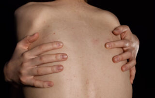 Dermatitis atópica y su cuidado integral - Dermatoclinic