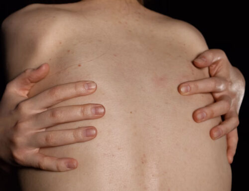 Dermatitis atópica y su cuidado integral