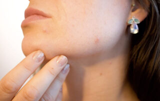 Acné, más allá de la adolescencia - Dermatoclinic