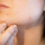 Acné, más allá de la adolescencia - Dermatoclinic