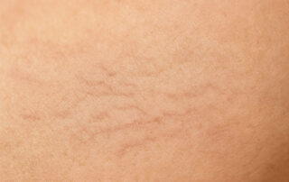 Arañas vasculares, qué son y cómo tratarlas - Dermatoclinic