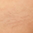 Arañas vasculares, qué son y cómo tratarlas - Dermatoclinic