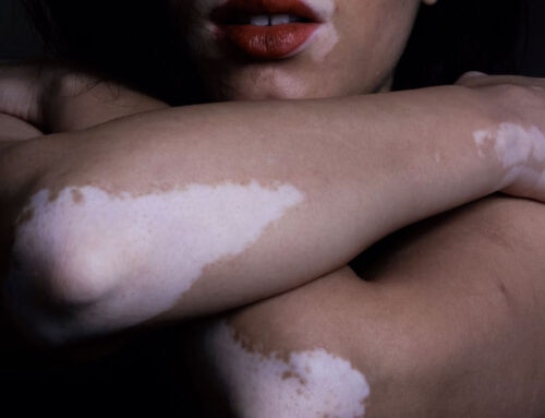 Enfermedades autoinmunes con manifestación cutánea