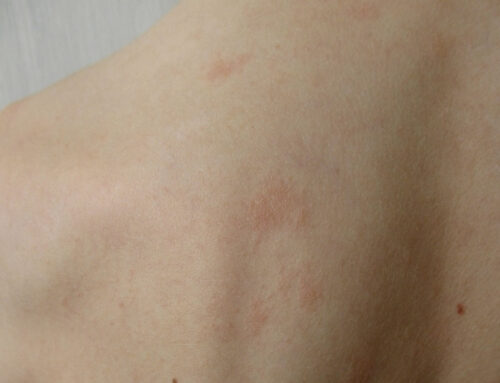 Urticaria: guía completa sobre causas, riesgos y soluciones dermatológicas