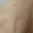 Urticaria: guía completa sobre causas, riesgos y soluciones dermatológicas -Dermatoclinic.jpg