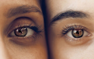 Blefaroplastia en Dermatoclinic, transforma tu mirada