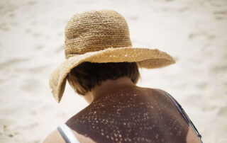 Manchas solares en verano, prevención y tratamiento - Dermatoclinic