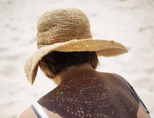 Manchas solares en verano, prevención y tratamiento